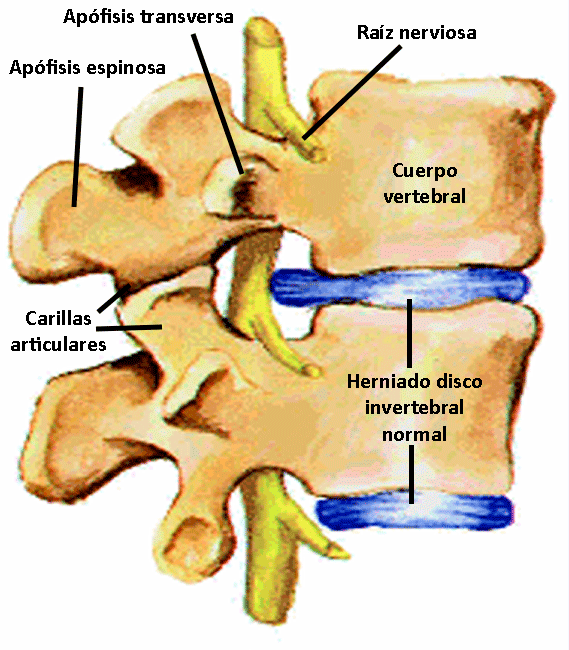 dolor lumbar
