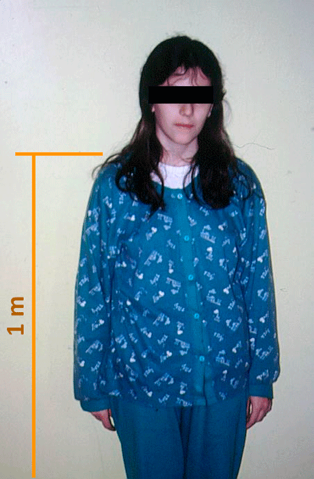 paciente femenina con insuficiencia hipofisiaria 